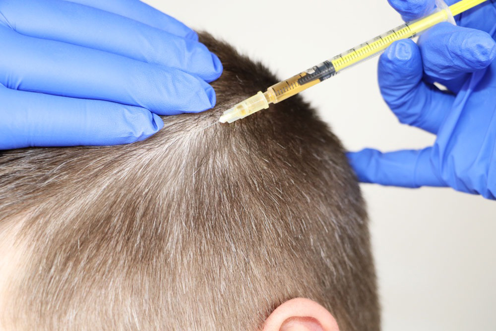Mesotherapy For Hair Growth In Gurugram